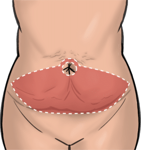 Incisions for full abdominoplasty