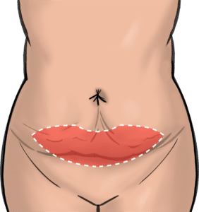 Incisions for mini-abdominoplasty