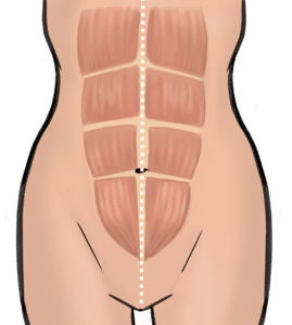 Rectus plication to tighten rectus abdominis muscles