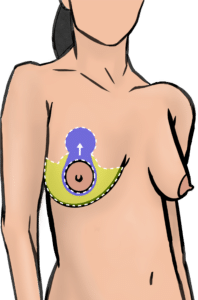 A breast can be enlarged with an implant and lifted at the same time. Skin is removed and the nipple is lifted on a tissue bridge called pedicle (purple), resulting in anchor shaped scars