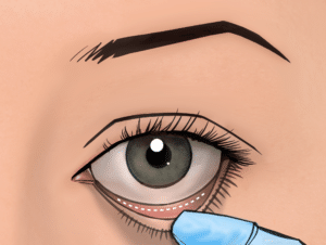 Scars inside the lower eyelid to correct eye bags are suitable if no excess skin has to be excised
