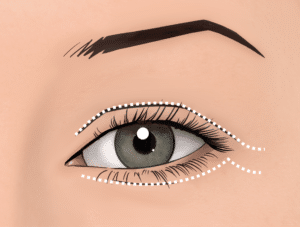 Scars in upper and lower blepharoplasty (if skin is removed)