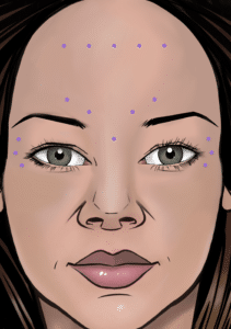 Injection sites to improve forehead lines, frown lines and “crow’s feet”