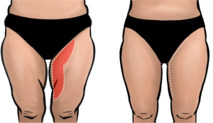 A thigh reduction excises excess skin from the inner thighs