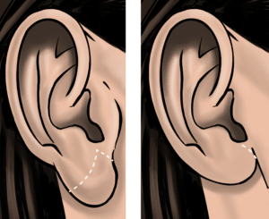 Large earlobes can be reduced, leaving a small scar in the lower earlobe
