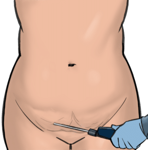 A prominent pubis with good skin can be reduced with liposuction