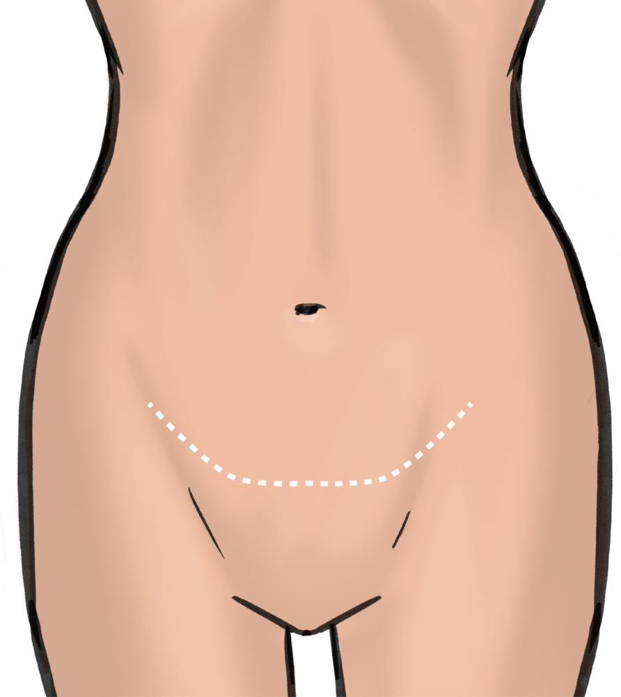 https://adore.life/wp-content/uploads/2021/01/PBL_Scar-for-Pubic_Lift.png