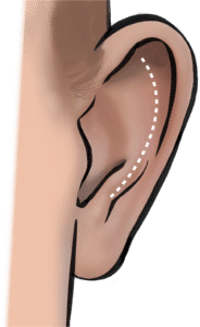 An underdeveloped antihelical fold is a common cause of prominent ears