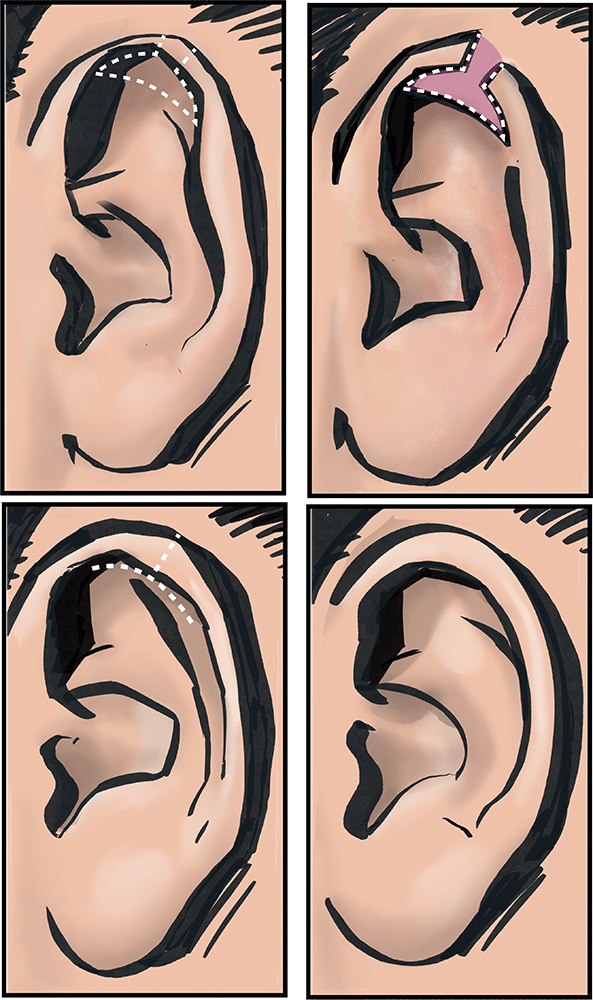 For Big Ears Ear Fold Corrector Adult Ear Corrector Transparent