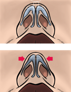 Sutures are used to narrow the width of the nasal tip