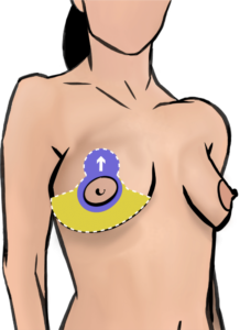 A capsular contracture around breast implants can distort the breasts. The implants can be removed and a droopy breast can be lifted at the same time. For a lift, skin is removed and the nipple is lifted on a tissue bridge called pedicle (purple), resulting in anchor shaped scars