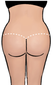 The resulting scar from a buttock and thigh lift at the back
