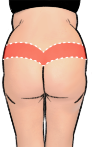 Excision of tissue from the lower back lifts mainly the buttocks
