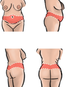A buttock and outer thigh lift can be combined with an abdominoplasty