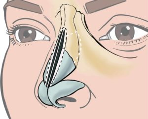 Osteotomies are cuts in the nasal bones, allowing them to be moved to the desired position.