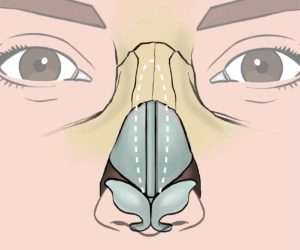 Prominent bone and cartilage is reduced from the nose