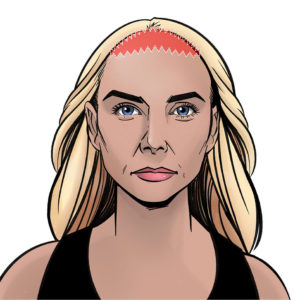 Before: The zig-zag design and the location along the hairline makes the scars less obvious.