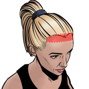 Before: Between 1 and 3 cm of skin can usually be removed in a forehead reduction